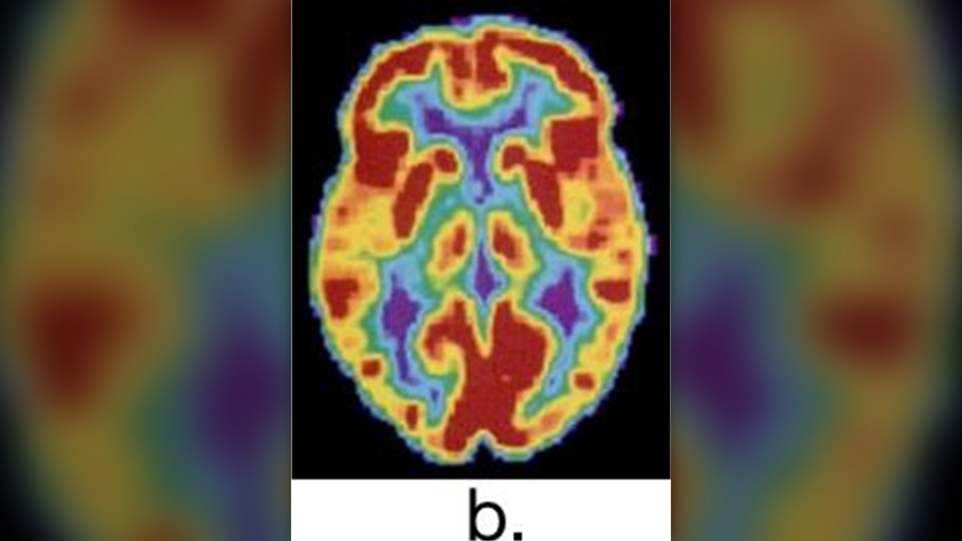 Medical neuroimaging scan displaying cerebral activity and brain structure