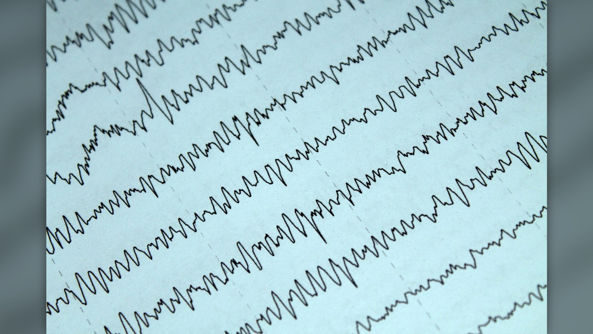 3. Massive Neurological Seizures
