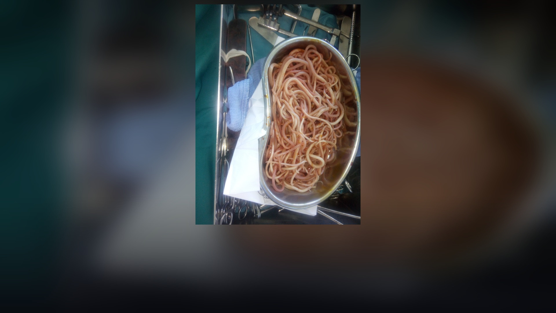 A clinical specimen of adult giant Ascaris lumbricoides roundworms.