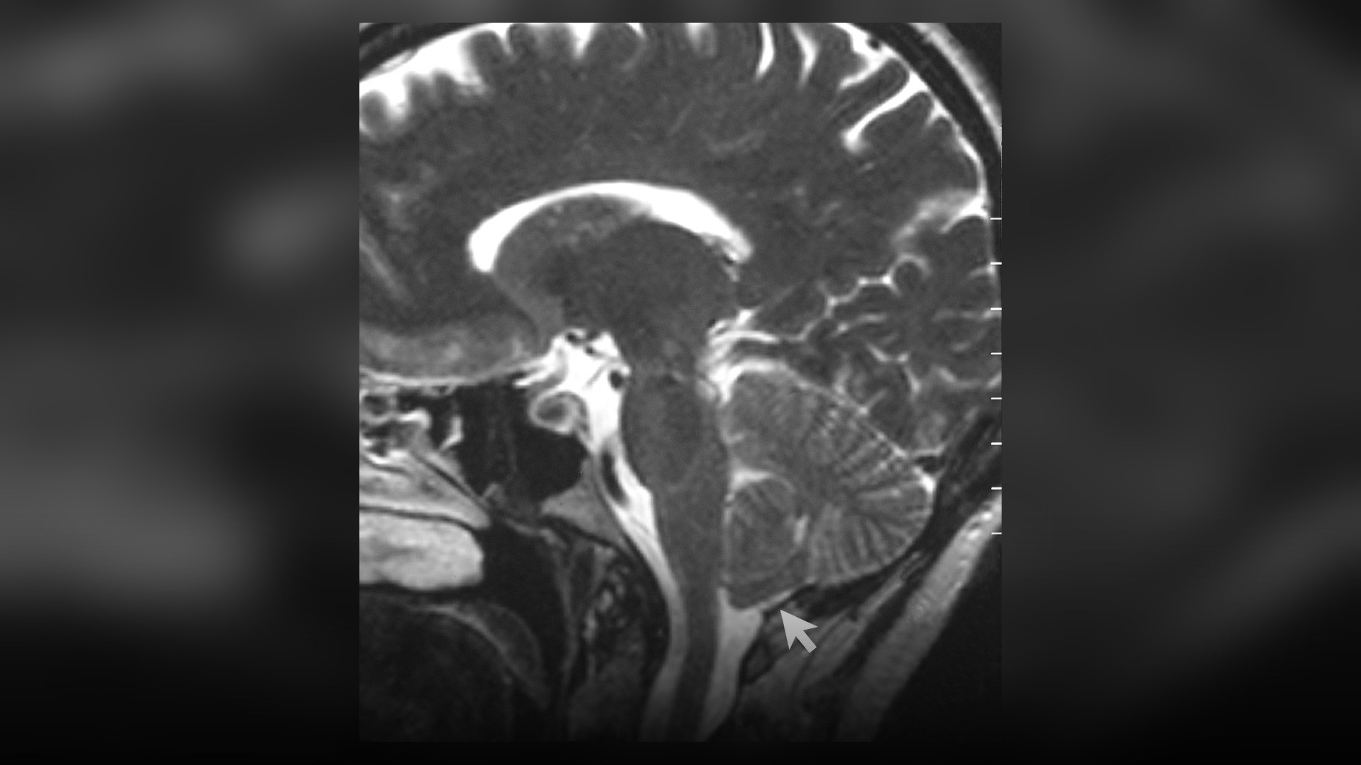A medical sagittal MRI cross-section scan displaying human brain anatomy and the frontal lobe region.