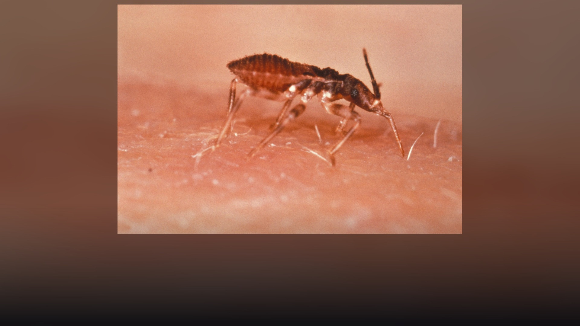 Clinical dorsal view of a Triatoma infestans kissing bug showing striped outer abdomen margin.