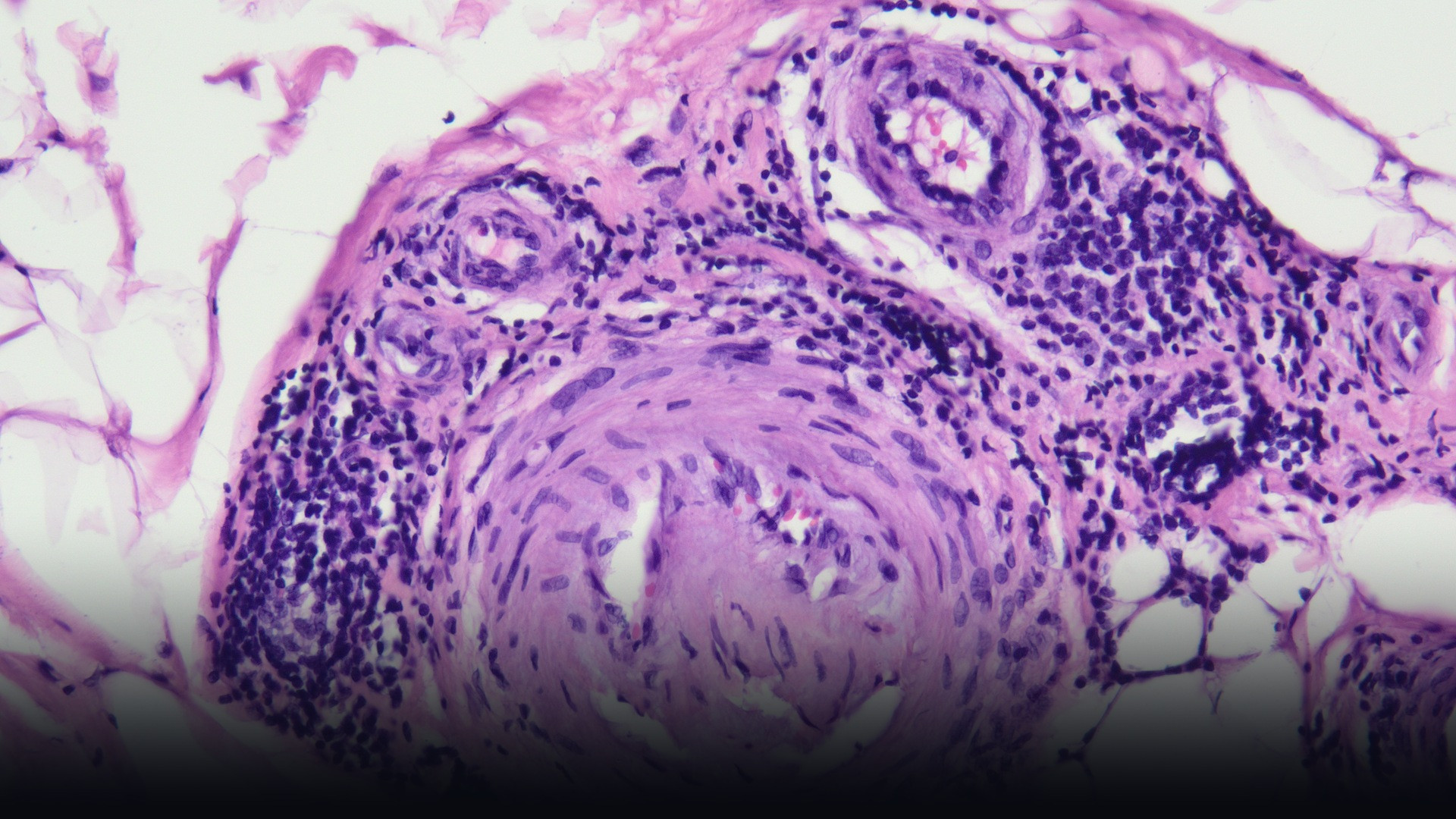 Histopathological cross-section of peripheral nerve tissue displaying inflammatory vasculitic neuropathy.