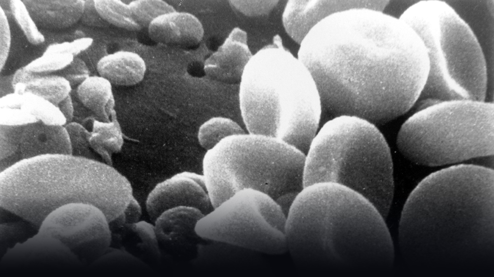 Colorized scanning electron micrograph of red blood cells enmeshed in a dense fibrin clot network.