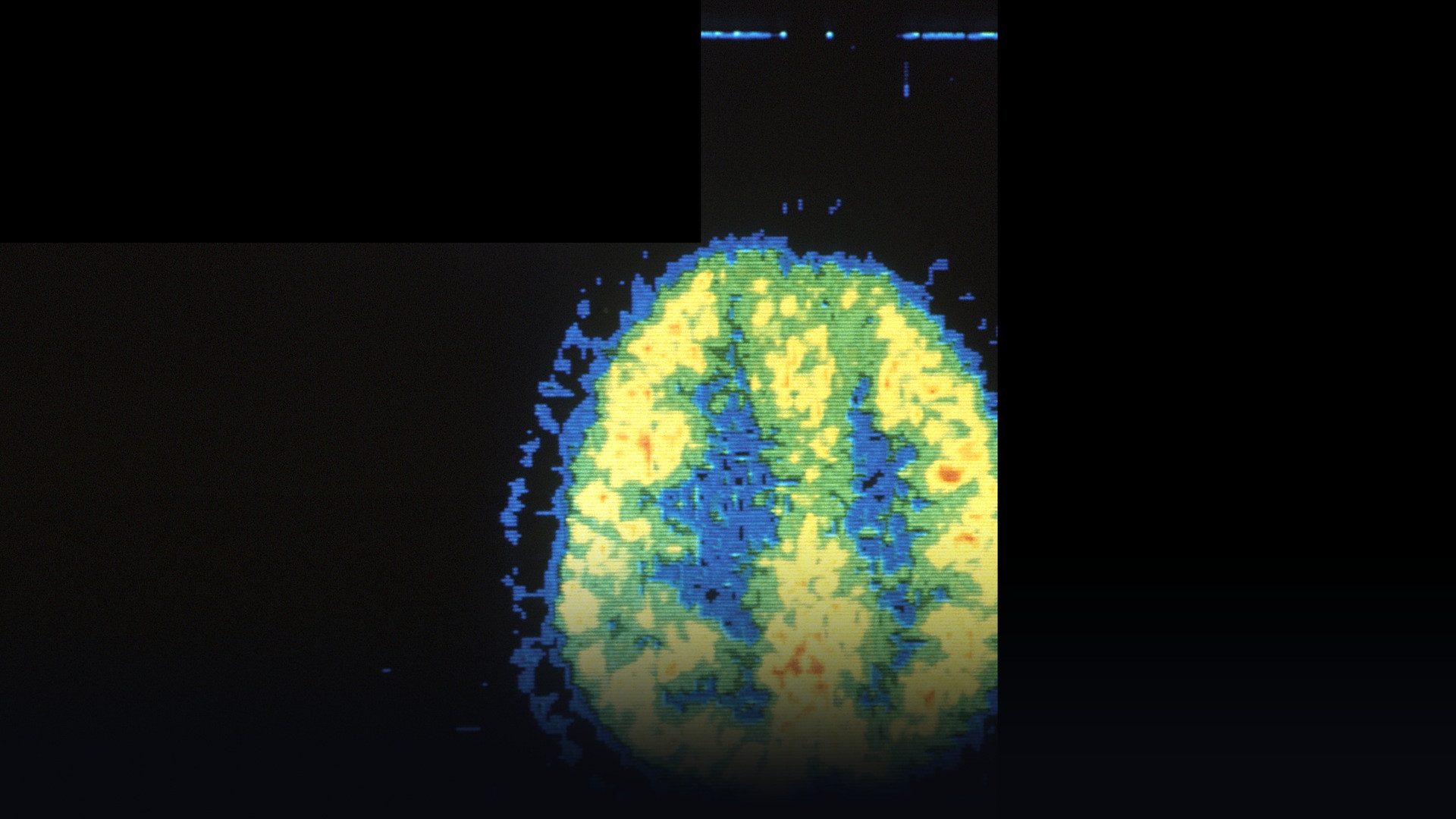 Axial PET brain scan showing high-resolution metabolic tracer distribution in cortical tissue.